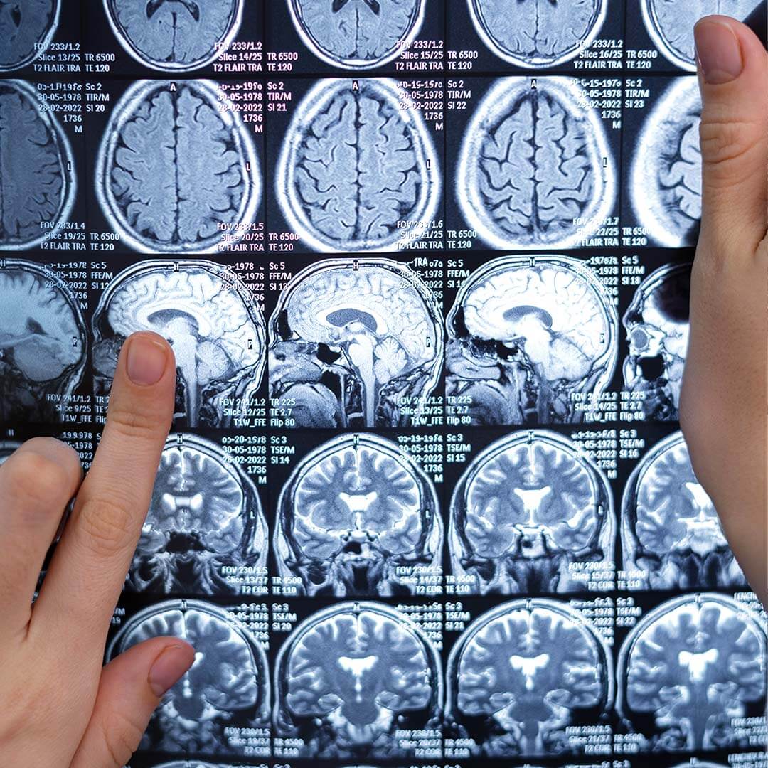 Hare Wynn Trial Lawyers - Top-Rated Catastrophic Injury Lawyers in Fairhope Heights AL - Brain Injuries Due to Medical Malpractice Hare Wynn Trial Lawyers - Top-Rated Catastrophic Injury Lawyers in Fairhope Heights AL - Brain Injuries Due to Medical Malpractice