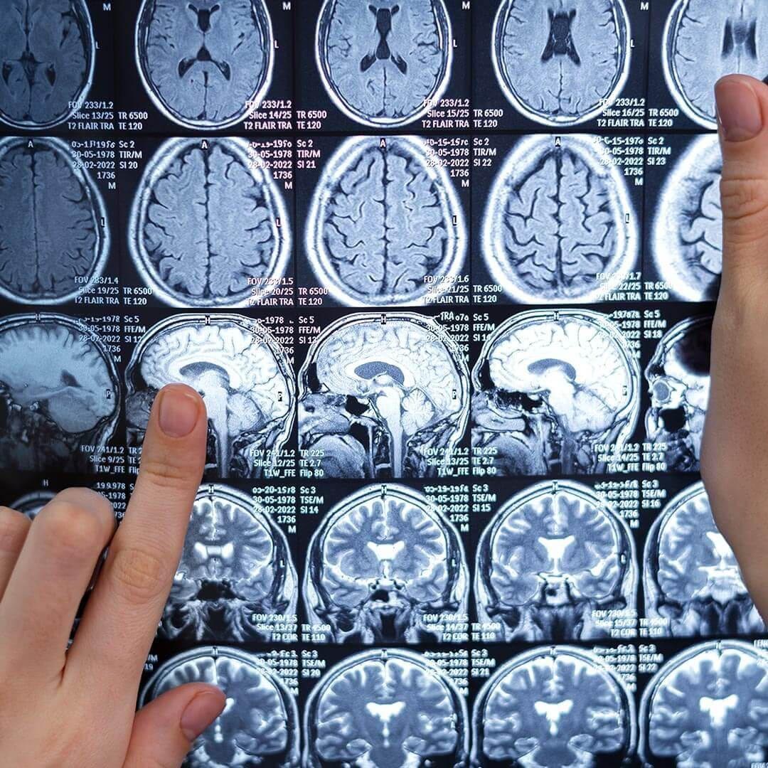 Hare Wynn Trial Lawyers - Compassionate Birth Injury Lawyer in Enterprise AL - Hypoxic‑Ischemic Encephalopathy (HIE)