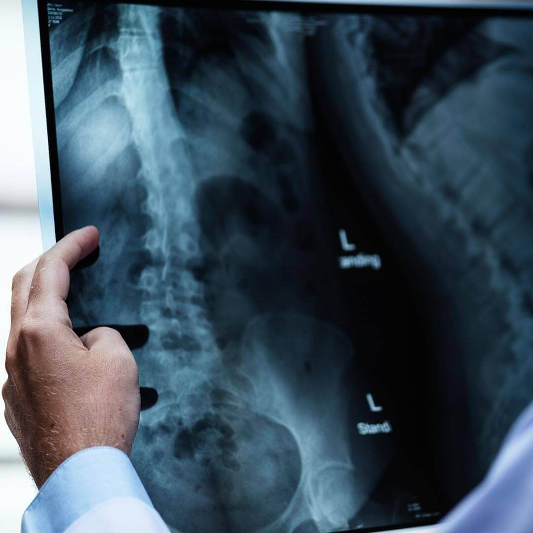 Hare Wynn Trial Lawyers - Leading Birth Injury Lawyer in Helena AL - Skull or Spinal Fractures